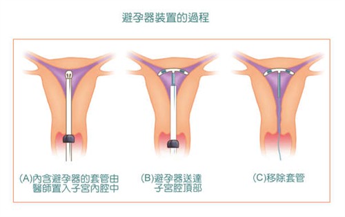 主要避孕<em>方式</em>,以及优缺点和失败率 孤独男女的