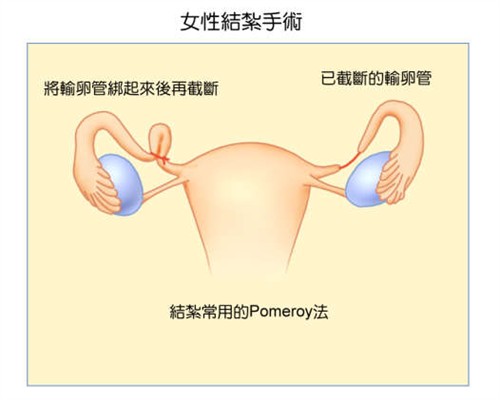 主要避孕<em>方式</em>,以及优缺点和失败率